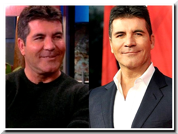 Simon Cowell Admit to Use Botox Injection but Rejects to Undergo Plastic Surgery